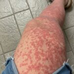 Pokrzywka? Alergia? Całe ciało ją swędziało; lekarze zdiagnozowali najgorszą diagnozę