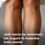 Dlaczego latem na skórze pojawiają się białe plamy i jak sobie z nimi radzić? Odpowiada dermatolog